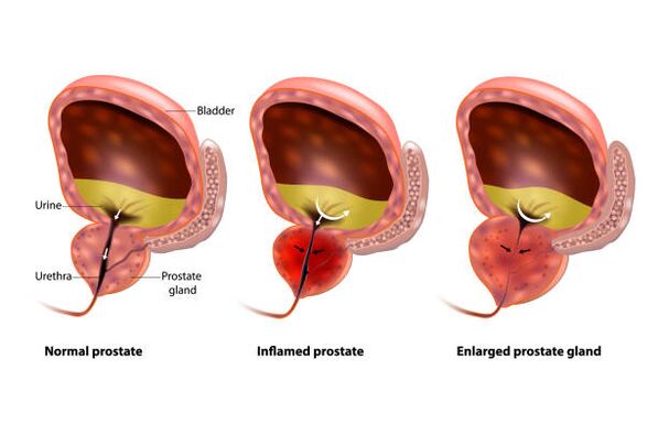 Ang prostatitis usa ka panghubag sa prostate gland