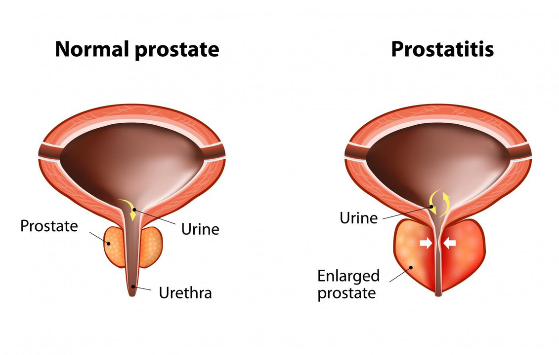 Normal nga prostate sa usa ka himsog nga tawo ug panghubag sa prostate gland nga adunay prostatitis