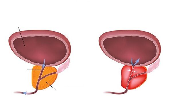 normal ug inflamed prostate